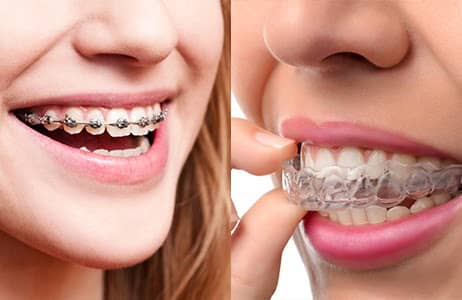 Invisalign Vs Braces - Murray Orthodontics by orthodonticss on